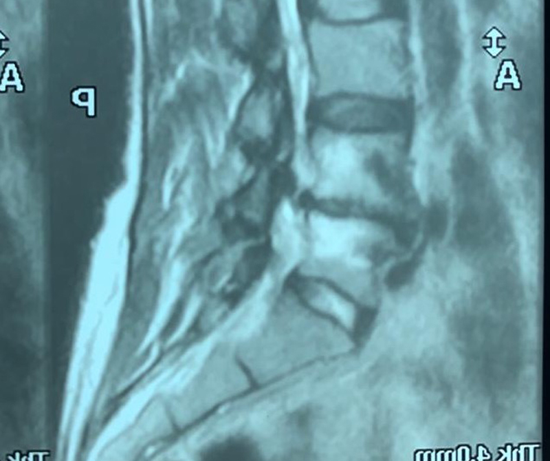45-El tractament per a protrusió discal a través de la quiropràctica