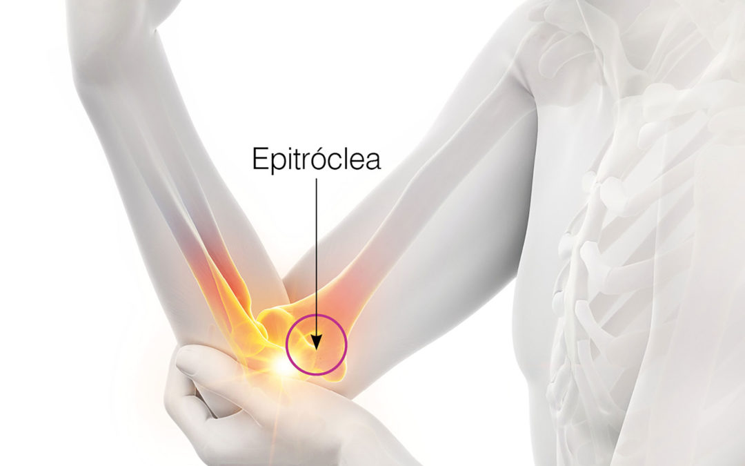 Epitrocleitis or “golfer’s elbow”.