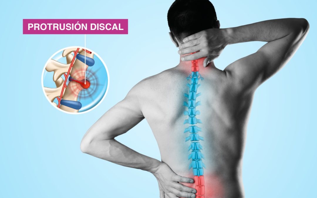Treatment for Disc Protrusion and Chiropractic