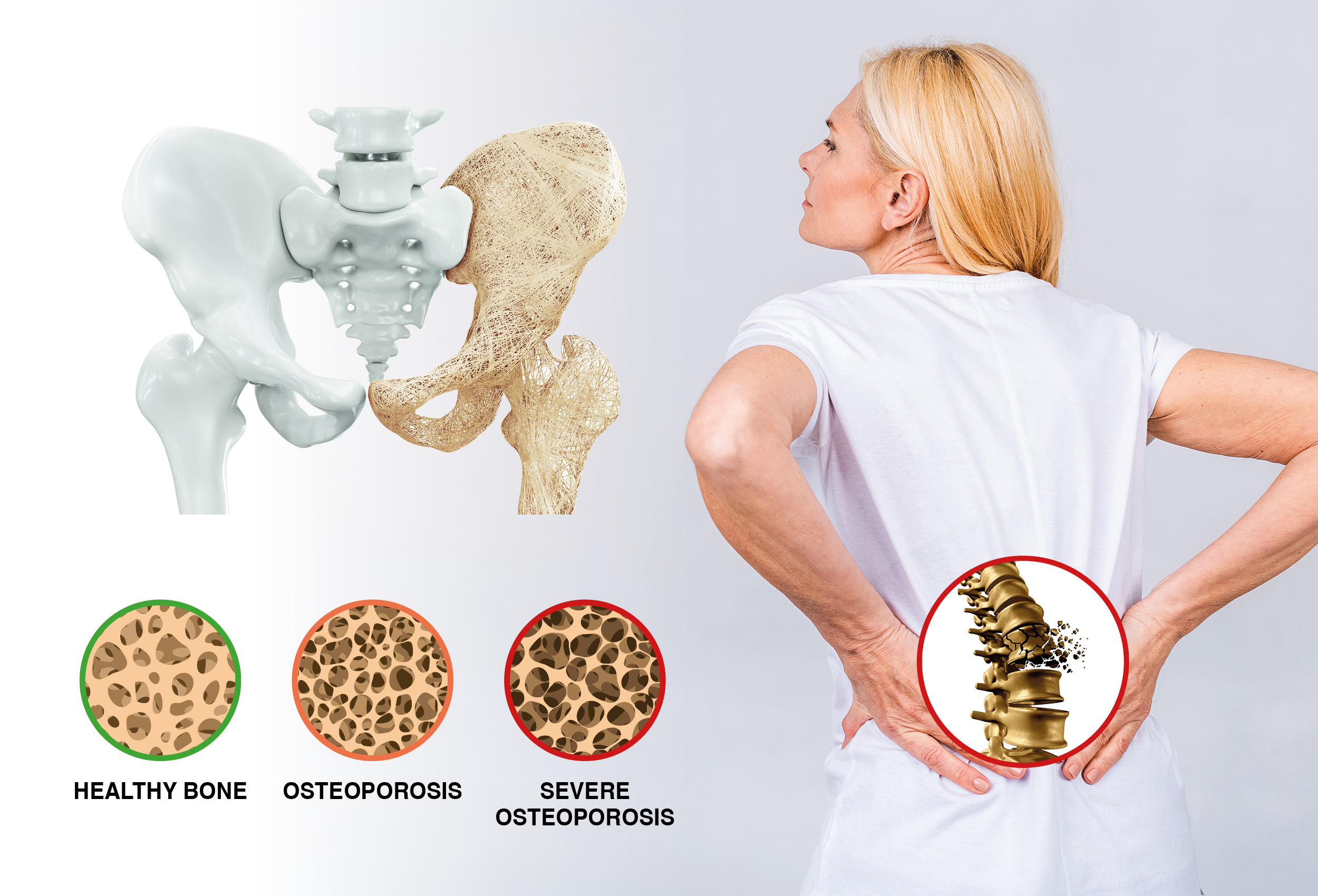 osteoporosis_chiropractic
