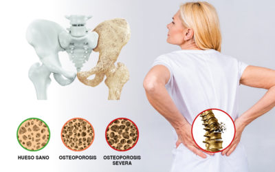 Osteoporosis ¿Tratamiento Quiropráctico?