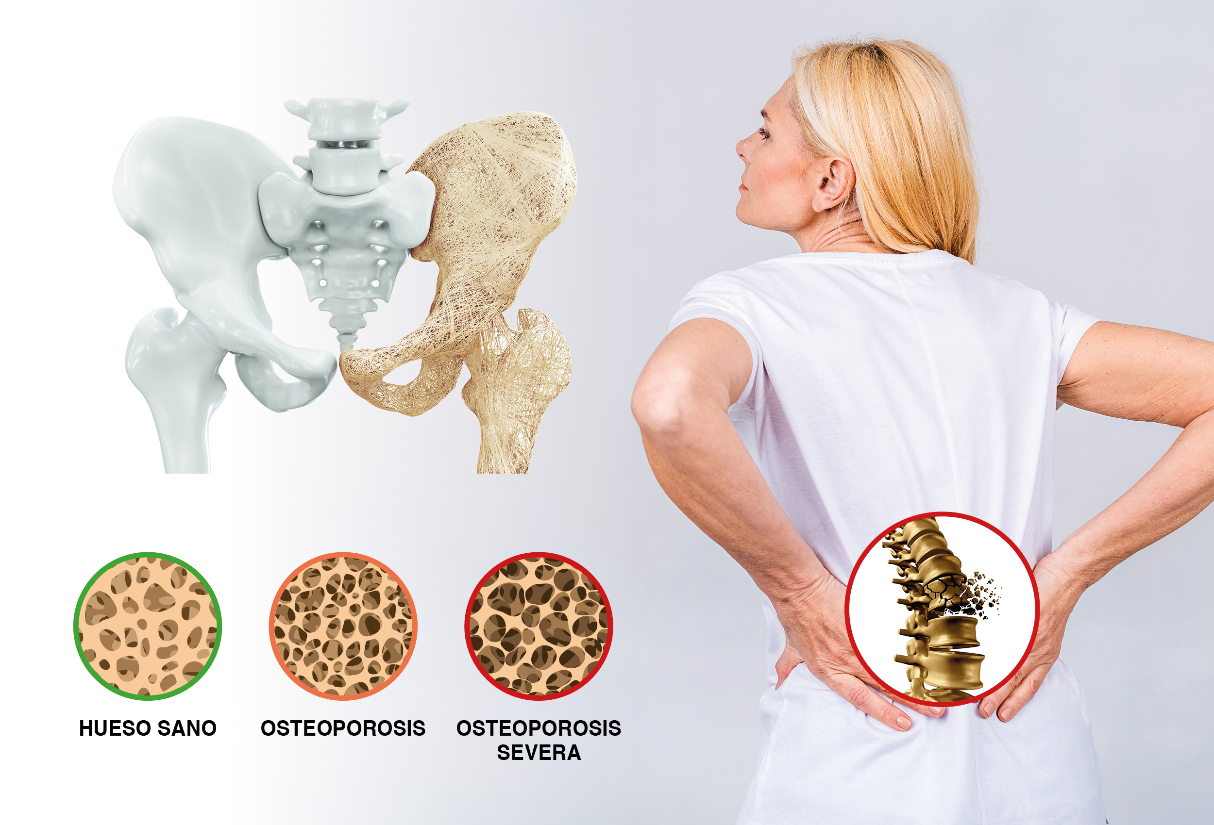 osteoporosis_quiropractica