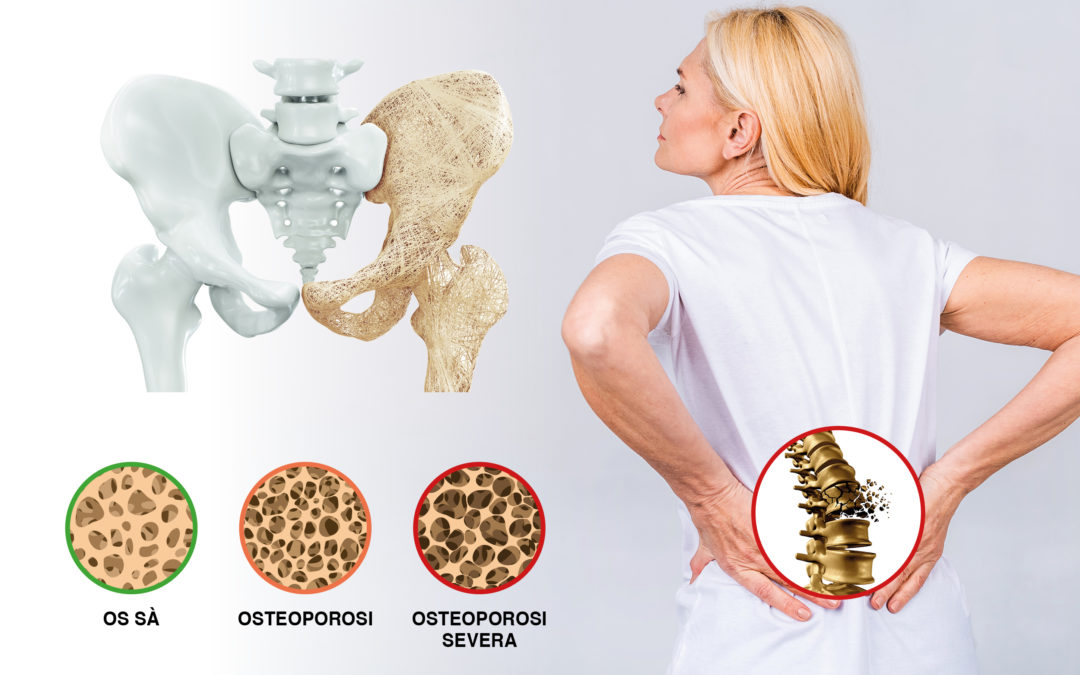 Osteoporosi Tractament Quiropràctic?
