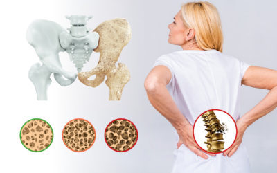 Osteoporosis ¿Tratamiento Quiropráctico?