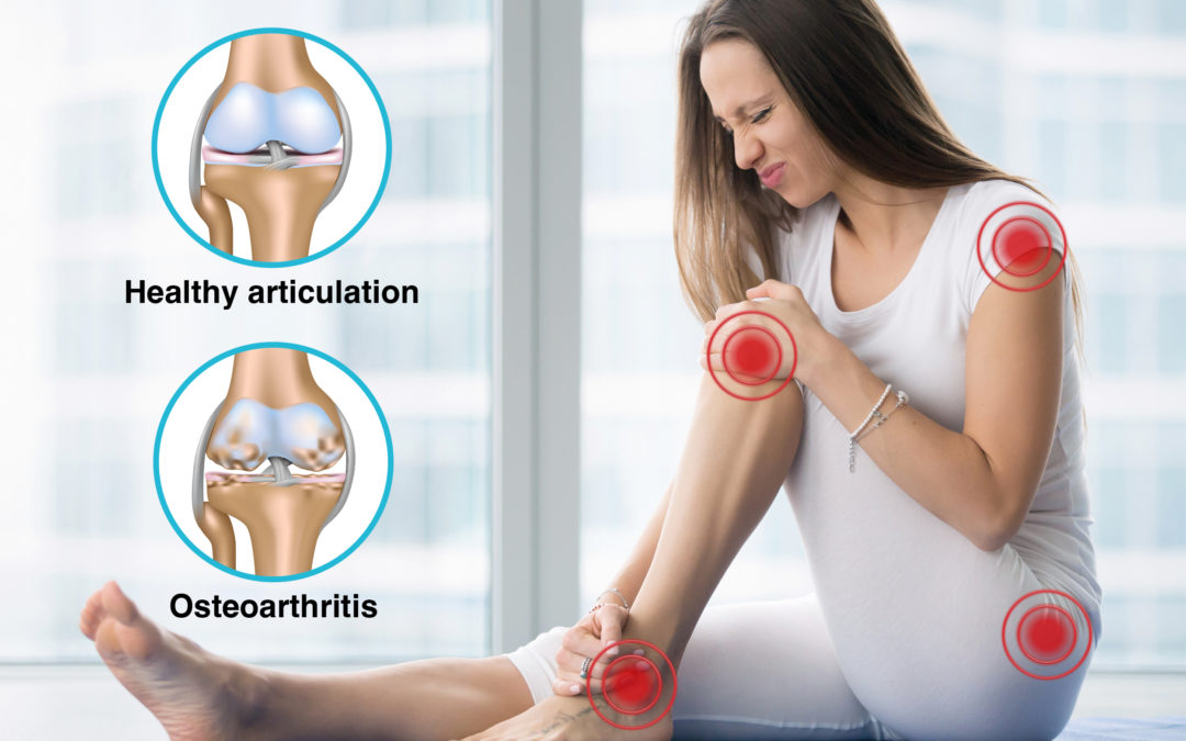 Treatment for osteoarthritis: put your trust in chiropractic